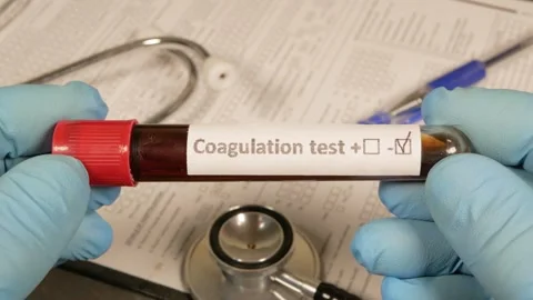 Doctor showing positive coagulation test tube Stock Footage 312763277