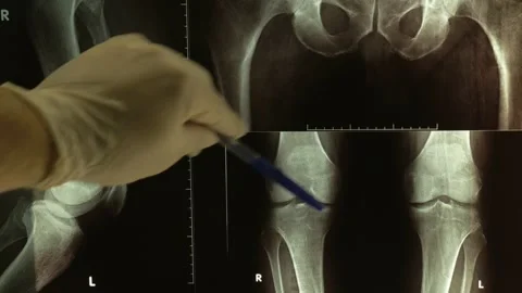 A doctor shows a problem in a patient's left and right knee joints on x-rays Stock Footage 284921351