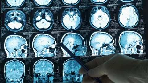 The doctor shows on X-ray the problems in the patient's brain. Stock Footage 271235369