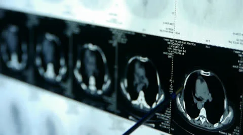Doctor study Breast pet-ct scan,medical x-ray. Stock Footage 22944573