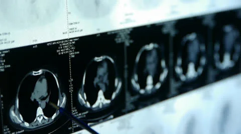 Doctor study Breast pet-ct scan,medical x-ray. Stock Footage 22944762