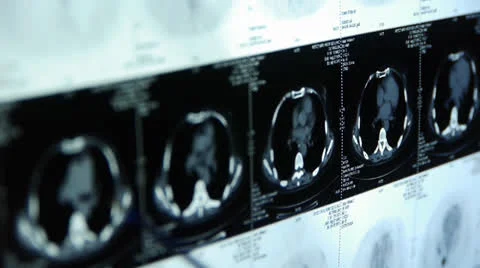 Doctor study Breast pet-ct scan,medical x-ray. Stock Footage 22944944