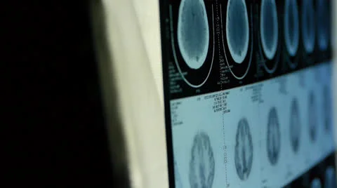 Doctor study head pet/ct scan for analysis the disease,skull brain X-ray. 库存影片 22943915