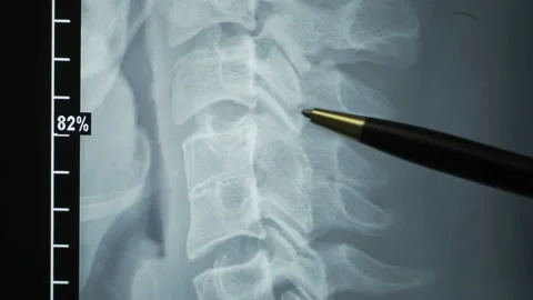 A doctor is studying a spinal X-ray. The patient has accrete vertebrae Video stock 99184828
