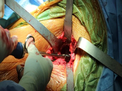 Doctor Surgeon screwing in hip replacement during surgery Stock Footage 80274210