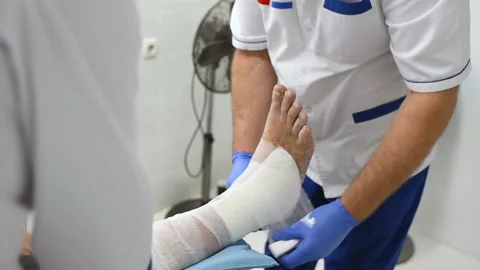Doctor traumatologist puts a plaster on the broken leg of the patient. Stock-Footage 100605370