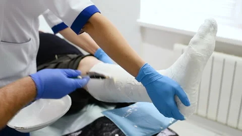 Doctor traumatologist puts a plaster on the broken leg of the patient. Stock-Footage 100606060