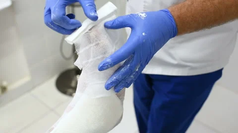 Doctor traumatologist puts a plaster on the broken leg of the patient. Stock-Footage 101436318
