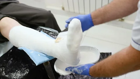 Doctor traumatologist puts a plaster on the broken leg of the patient. Stock Footage 101436416