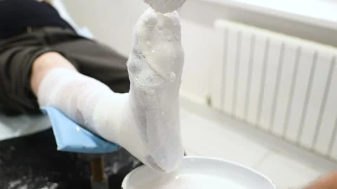 Doctor traumatologist puts a plaster on the broken leg of the patient. Video stock 102906145