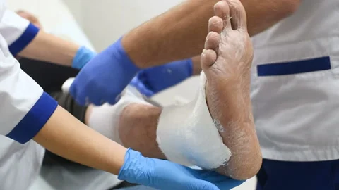Doctor traumatologist puts a plaster on the broken leg of the patient. Video stock 102909885