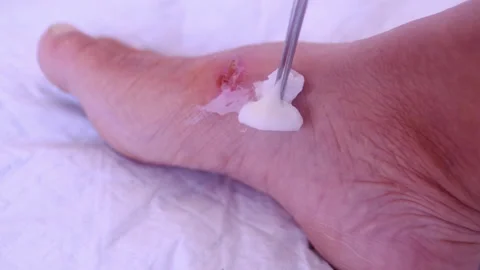 doctor treats weeping wound, trophic ulc... Stock Video Pond5