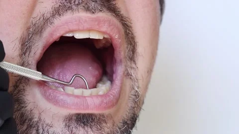 A doctor uses a dental hook to check the condition of a man's teeth Video stock 346703359