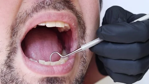 A doctor uses a dental hook to check the condition of a man's teeth Video stock 346703360