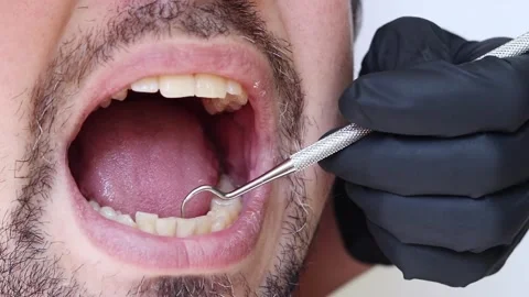 A doctor uses a dental hook to check the condition of a man's teeth Video stock 346703363