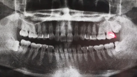 The doctor uses a laser pointer on the X-Ray dental problem. Stock Footage 108108069