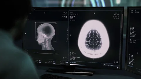 Doctor uses an x-ray scanner to study the damaged brain of an ill person Vídeo Stock 277941232