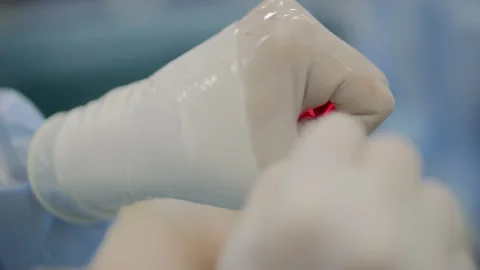 Doctor using laser fiber during endovenous vein treatment Stock Footage 320786870