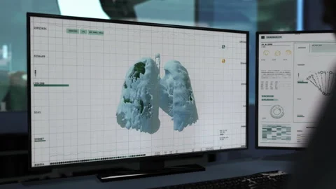 A doctor using Lung CT Scan to identify the virus. Covid-19 Pneumonia was found. Stock Footage 268205851