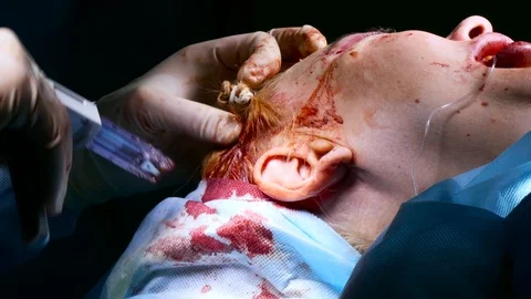 Doctor using a surgical stapler to close a wound on a patient's head with metal  Stock Footage 123572312