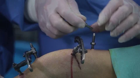 Doctor using wrenches tighten the nuts on the apparatus Elizarova on the broken Video stock 73038520