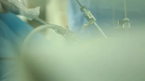 Doctors are performing surgery 5 Stock Footage 317081298