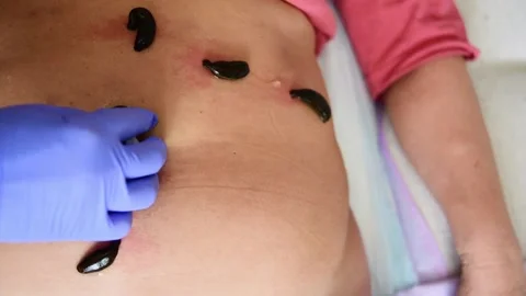 Doctor's blue-gloved hand removes the leeches from the patient's navel. Leeches Stock Footage 133217329