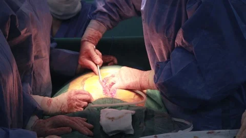 Doctors Doing Surgery Stock Footage 128747964