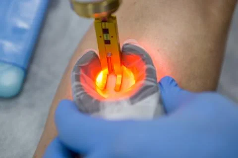 Doctors doing vein surgery procedure Stock Photos