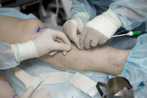 Doctors doing vein surgery procedure Stock Photos