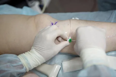 Doctors doing vein surgery procedure Stock Photos