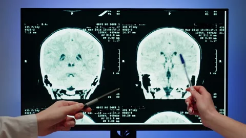 Doctors examining X-ray on computer monitor. Magnetic resonance image of head Stock Footage 194515274