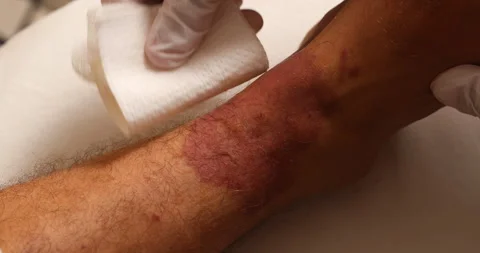 Doctor's gloved hands cleaning and wiping a severe red skin rash on a patient's  Stock Footage 340064445