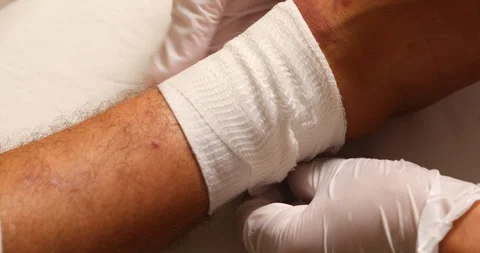 Doctor's gloved hands removing a bandage to examine and clean a severe skin rash Stock Footage 340064300