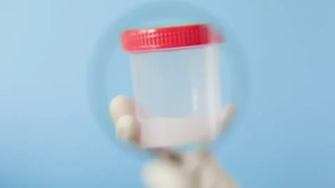 Doctor's hand holds a jar of sperm and examines it with a magnifying glass 動画素材 169338145