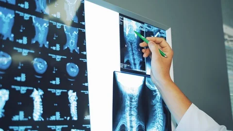 Doctor's hand with a pen shows the elements on the x-ray photograph.  Vídeos de archivo 110470882