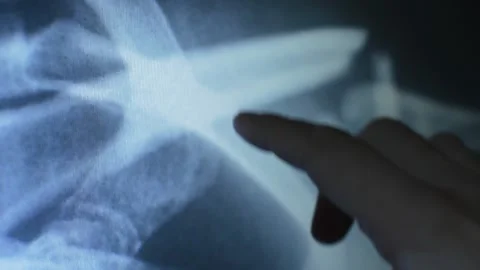 Doctor's hand study an human x ray scan on the hospital. Video stock 220845190