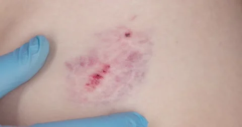 Doctor's hands in blue gloves sprays the antiseptic onto the wound on the pat Stock Footage 153172619