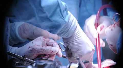 Doctor's hands in gloves do surgery Stock Footage 62746894