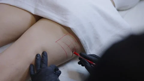 Doctors hands with gloves drawing the area to be treated with mesotherapy Stock Footage 255390895