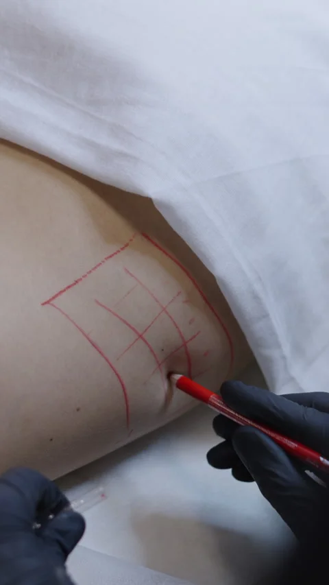 Doctors hands with gloves drawing the area to be treated with mesotherapy Stock Footage 264584870