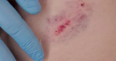 Doctors hands in gloves performs the treatment the wound with the help of oin Stock Footage 153114892