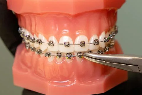 Doctors hands holding models of teeth ceramic braces teeth on an artificial jaw Stock Photos