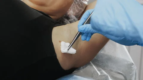 A doctors hands holding tweezers while removing a papilloma. Stock Footage 318942746