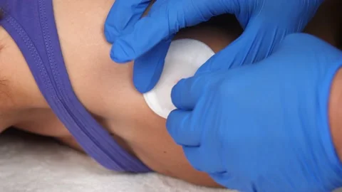 The doctor's hands in medical gloves remove the leech from the scar close-up Stock Footage 139730651