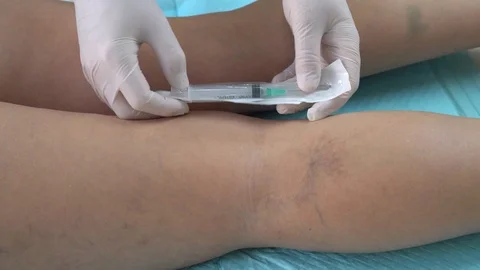 Doctor's hands open a syringe before injection. sclerotherapy. Stock Footage 124369500
