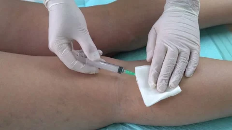 Doctor's hands open a syringe before injection. sclerotherapy. Stock Footage 161669341