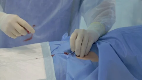Doctor’s hands, operating room, inserts probe, circulatory system, thin wire Video stock 128642819