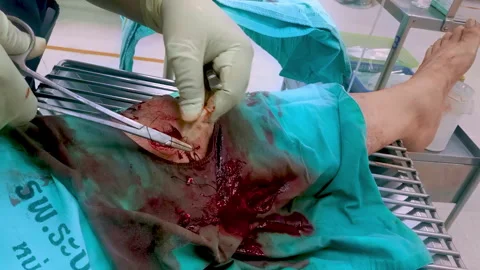 Doctor's hands stitching a wound on a leg. Medical operation. Military medicine Stock Footage 308912192