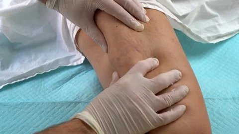 Doctor's hands in white latex gloves examines the veins of a woman with varicose 스톡 동영상 124369293